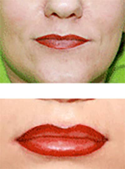 Lippeneinschattierung Behandlungsbeispiel